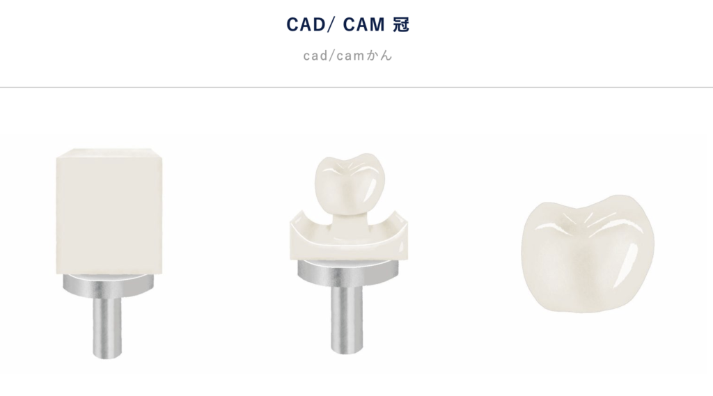 CAD/CAM冠の構造と見た目を示す画像。全体が白く、保険適用の範囲で自然な歯のように仕上がる被せ物。