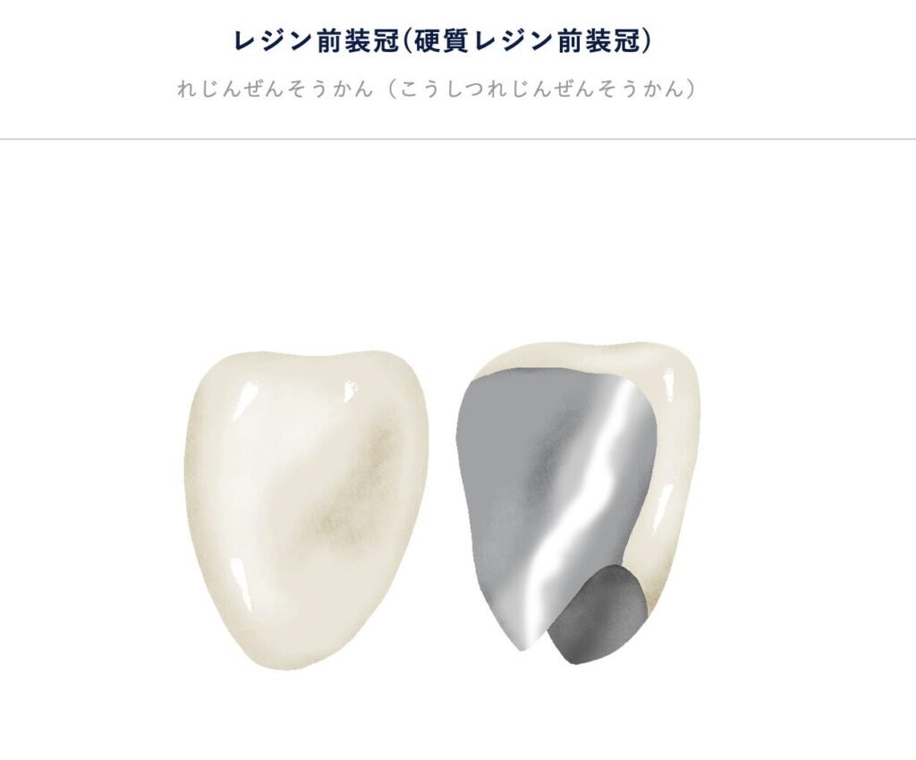 硬質レジン前装冠（前装金属冠）の画像。内側が金属、外側が白いレジンで覆われた保険適用の被せ物。
