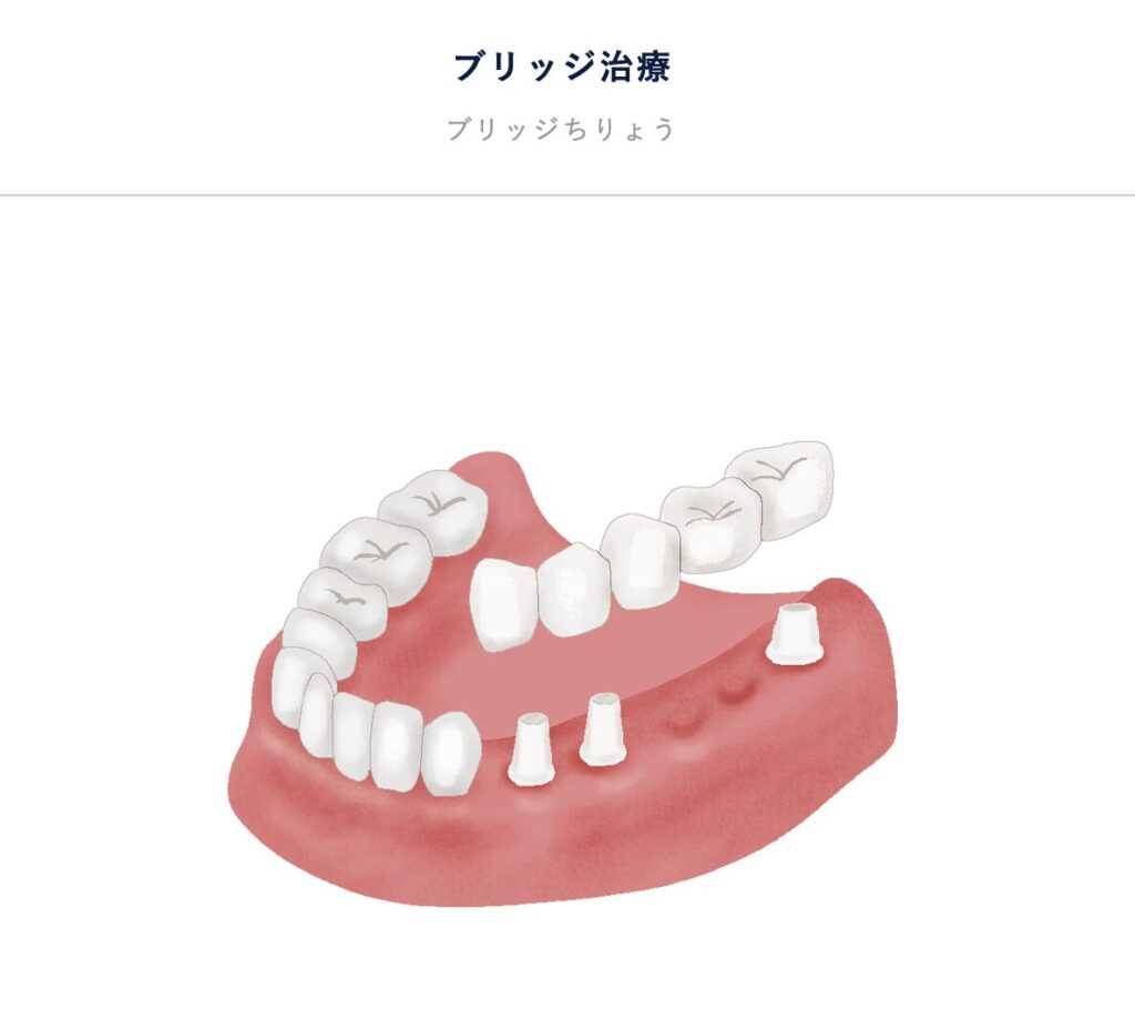 ブリッジ治療の模型図。抜けた歯の両隣の歯を削って土台にし、人工の歯を橋のように固定する治療法。